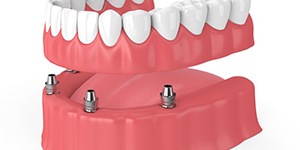 implant denture being supported by four dental implants 