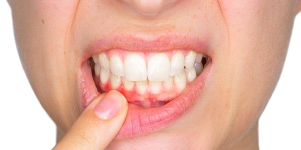 A person with mild gum disease.