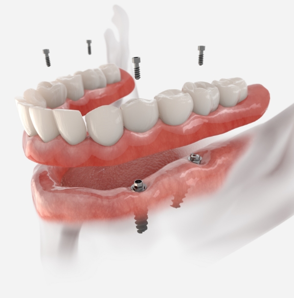 3D illustration of implant dentures