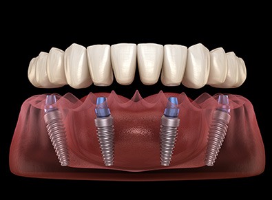 Digital image of an implant denture