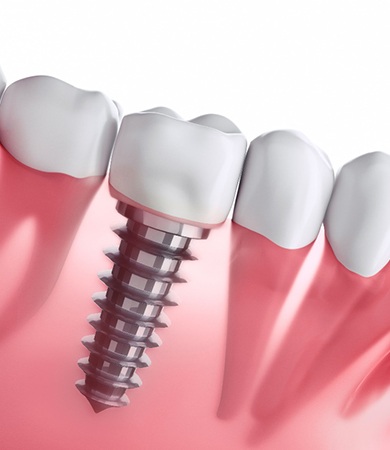 3D illustration of a dental implant in Glastonbury