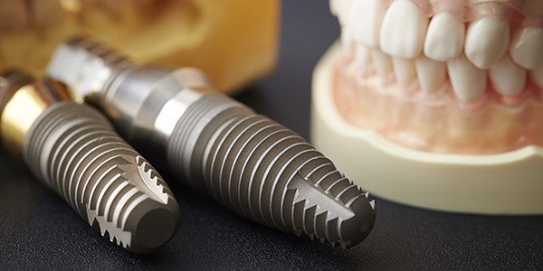 Close up of dental implants and model of a smile