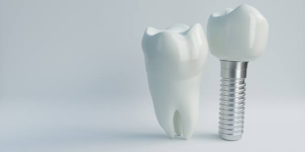 3D illustration of a dental implant and a tooth