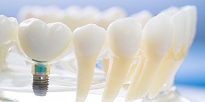 Model of dental implant with the rest of the smile