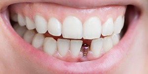 Close up of smile with dental implant but no restoration
