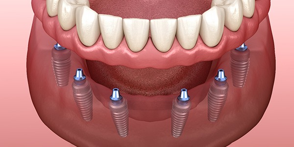 3D illustration of implant dentures