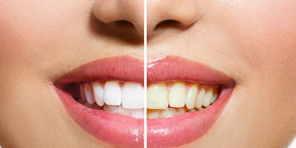A before and after image of a person’s teeth after whitening