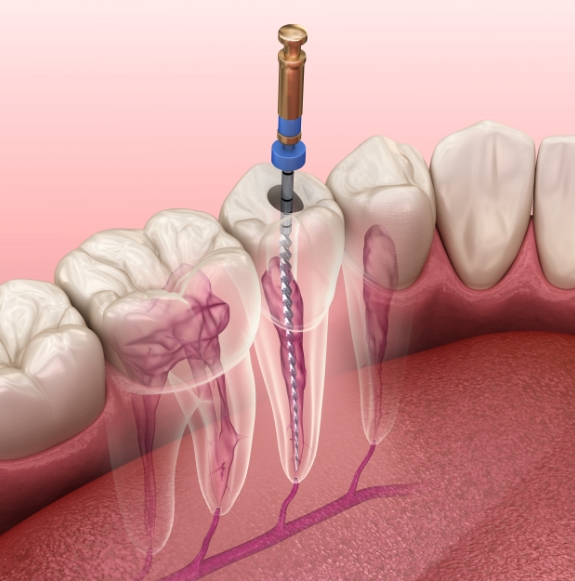 Model of the inside of the tooth