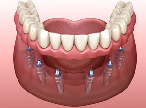 Illustration of dentures being placed on six dental implants