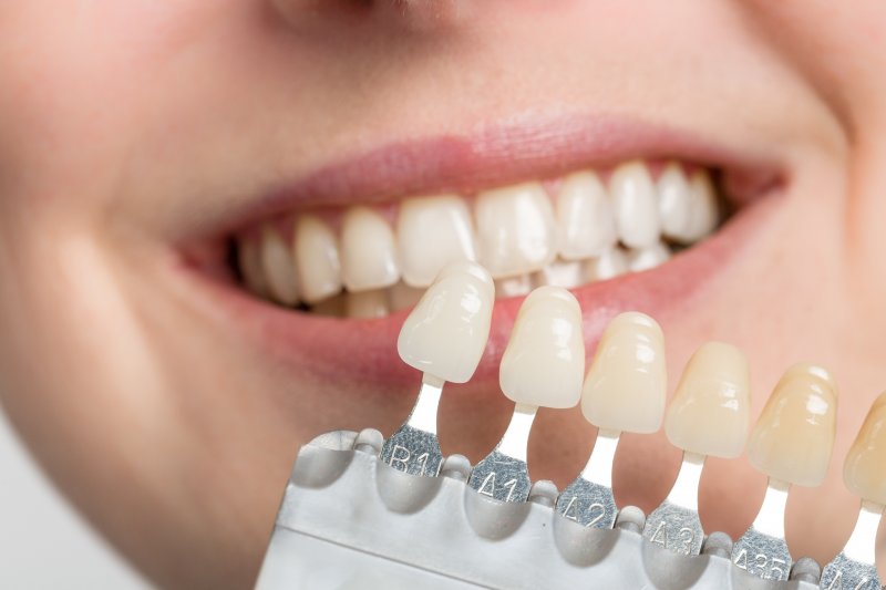 Veneer examples held up to woman's smile