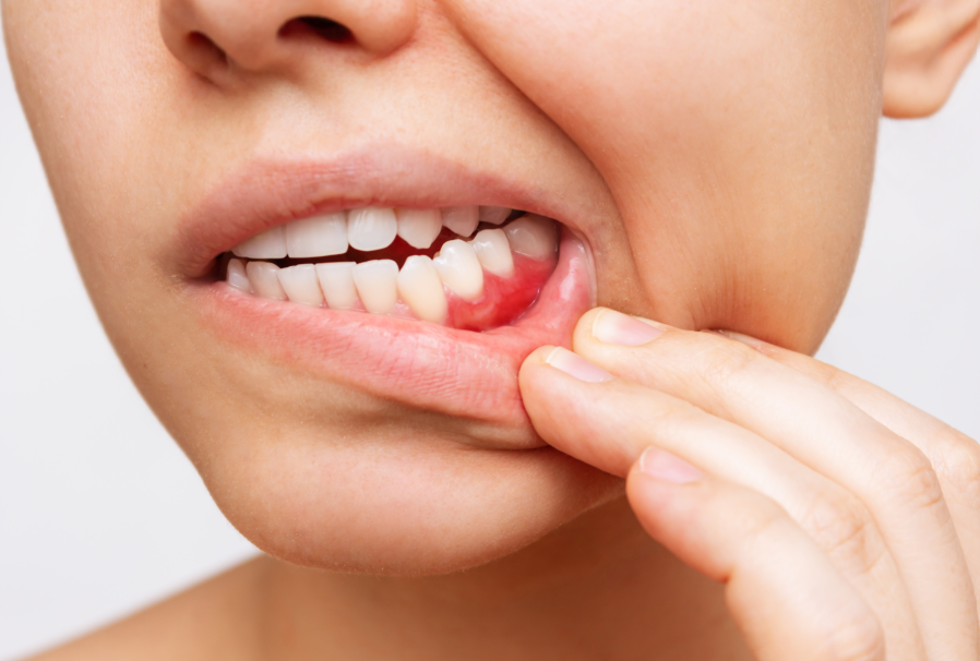 Close up of woman's mouth with inflamed gums